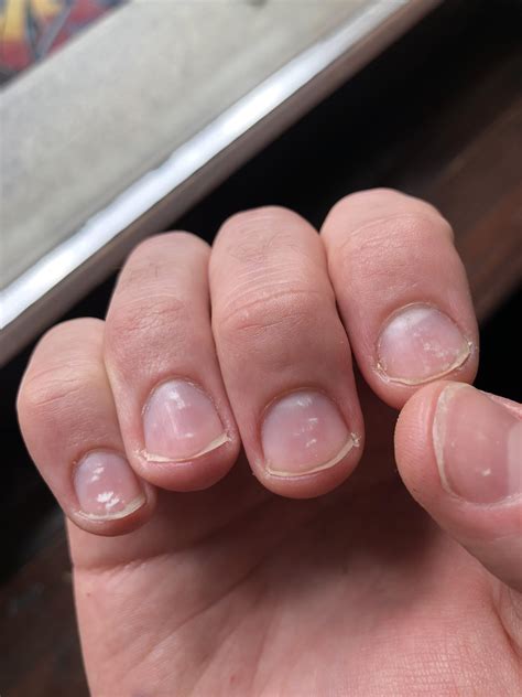 Is this fingernails fungus. I have fungus on my foot nails so i think