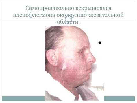 Лимфадениты. Формы хронического лимфаденита - презентация онлайн