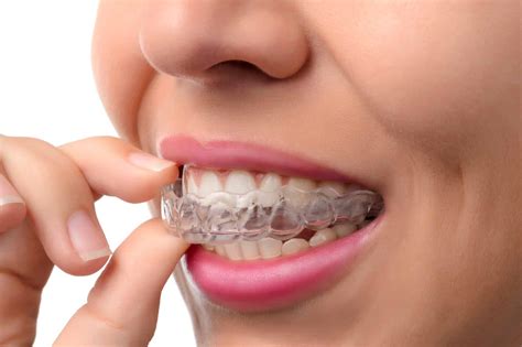 tips  living  invisalign clear aligners bailey orthodontics