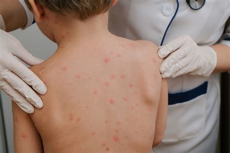 Understanding Chicken Pox - Medical Associates of Northwest Arkansas