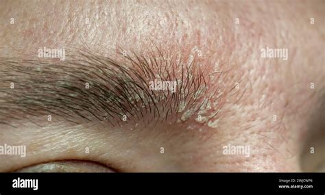 red eyebrows seborrheic dermatitis  amanda litherland blog