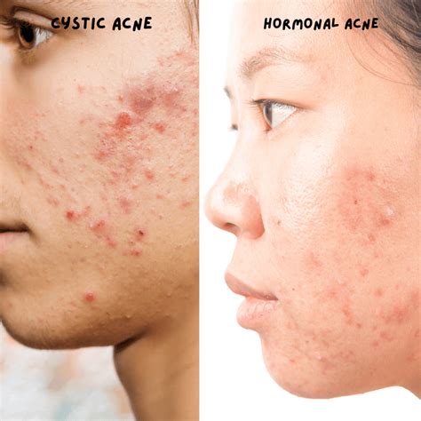 Cystic Acne: Dermatologists Explain Causes And Tips To, 50% OFF