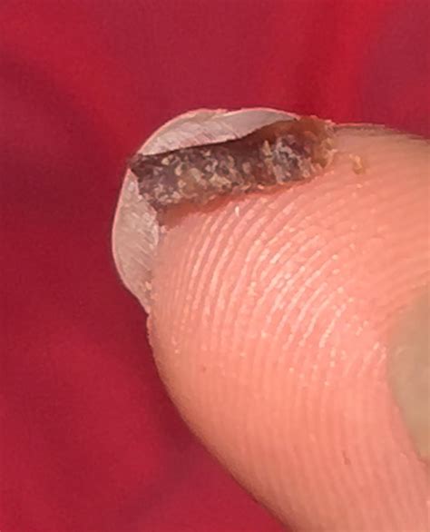 Surgery removal tmrw!! Why is dry blood under toenail? : r/Ingrown_Toenails