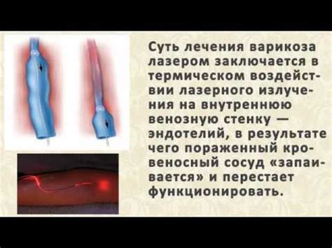 Гепариновая Мазь От Варикоза Отзывы [Гепариновая Мазь При Варикозе ...