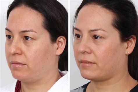 Blepharoplasty Before and After Photos | Dr. Benjamin Paul