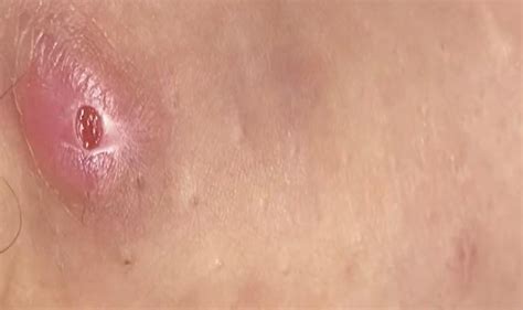 weird cyst   thigh    concerned rmedicaladvice