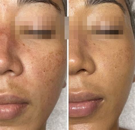 Hidroquinona Antes E Depois Virilha - Hidroquinona: Antes e depois