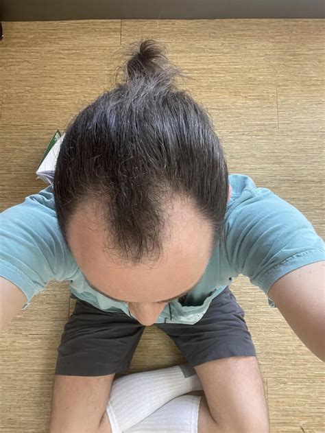 Update! [35FTM] w vegeta hairline pondering the buzz and the buzz won ...