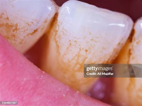 Plaque Bacteria Photos and Premium High Res Pictures - Getty Images