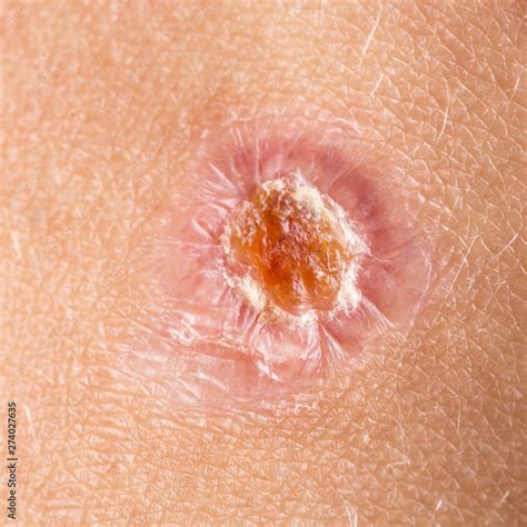 foto de  closeup view   small skin wound   healing process