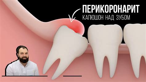 Перикоронарит, или что такое капюшон над зубом - YouTube