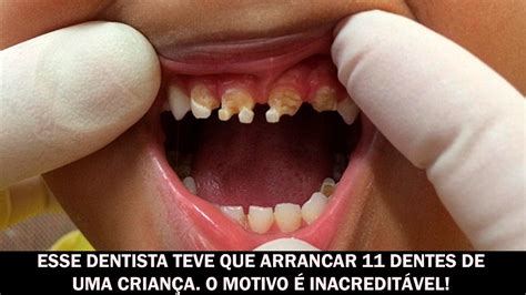 Dente De Criança Que Não Escova - Esse dentista teve que arrancar 11 dentes de uma criança. O motivo é ...