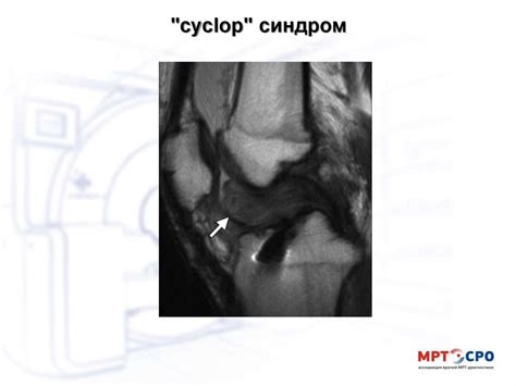 Возможности МРТ-визуализации в диагностике послеоперационных осложнений ...
