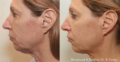 Morpheus Rosto Antes E Depois - Morpheus 8 | Clinica Dermavision