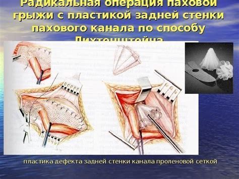 Топографо-анатомическо е обоснование образования наружных грыж и их