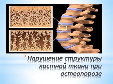 Остеопороз. Асептический некроз головки бедренной кости - презентация ...