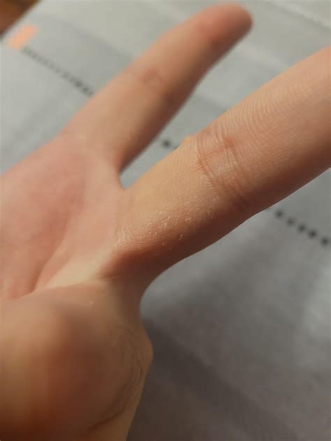 What is This? Very worried now : r/DermatologyQuestions