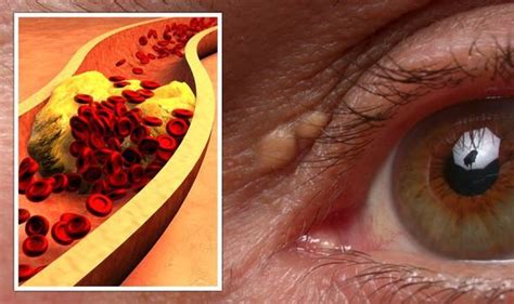 High cholesterol signs around your eye - why you shouldn't ignore this ...