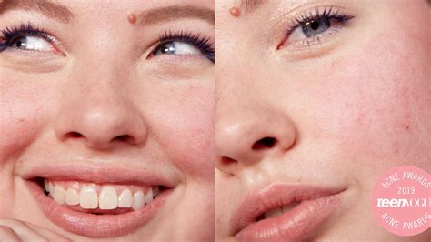 How To Reduce The Redness Of A Popped Pimple - Longfamily26