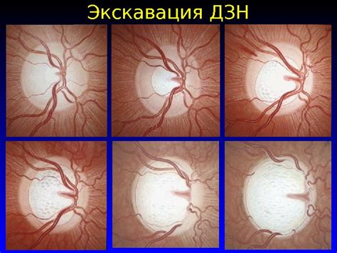 Презентация Глаукома
