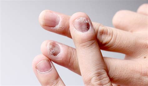 Nail Diseases: Types, Symptoms, Diagnosis, Medical Treatment