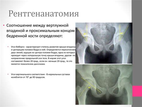Врожденный вывих бедра (дисплазия тазобедренного сустава) - презентация ...