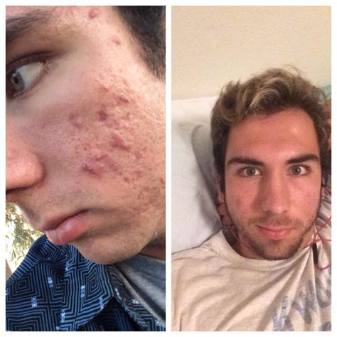 After years of struggling with acne, I'm finally happy with what I see