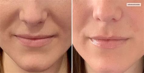 botox danger zones facial zones     avoid injecting