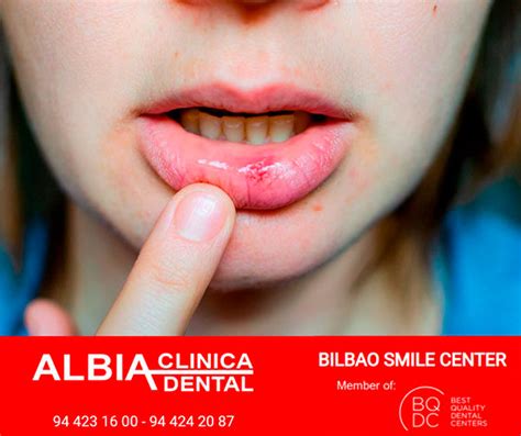 Botriomicoma y Cómo Tratarlo | Remedios y Soluciones