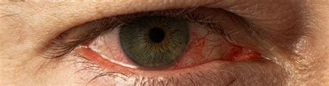 Um Olho Inchado O Que Pode Ser - Olhos inchados: o que pode causar e quando procurar um especialista ...