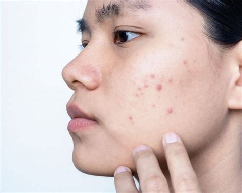 difference  teenage  adult acne skinmart