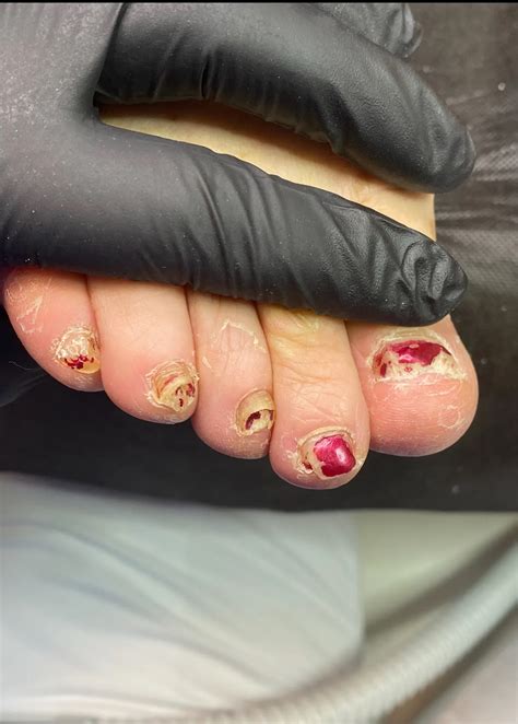 The most insightful stories about Toenail Fungus - Medium
