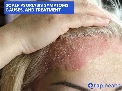 Scalp Psoriasis Symptoms, Causes, and Treatment - Tap Health