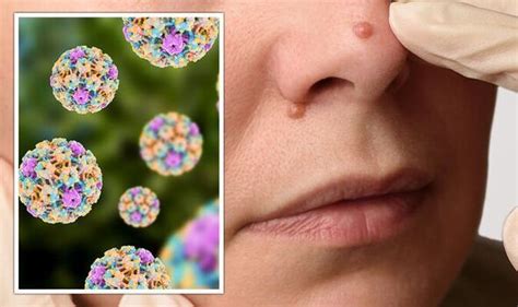 HPV symptoms: 4 types of wart that could mean you have this ‘very ...