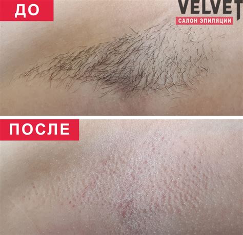 Эпиляция до и после: фото шугаринга и восковой депиляции