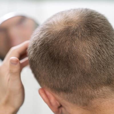 how long do hair transplants take to grow