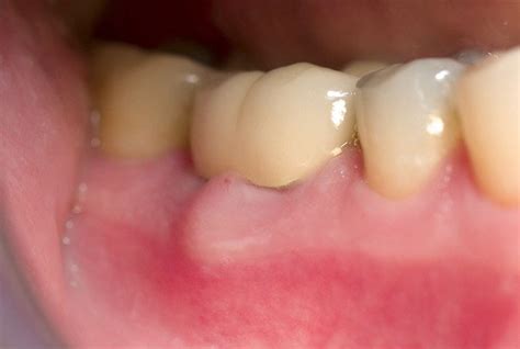 Gingival abscess - Definition of Gingival abscess