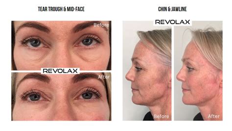 REVOLAX FINE | Korean Fillers