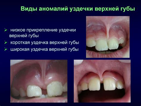 Аномалии развития слизистой оболочки полости рта - презентация онлайн