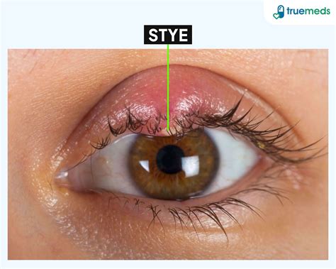 Stye Inside Eye Lid