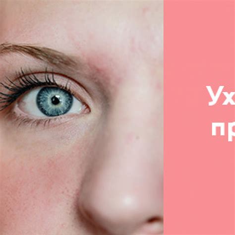 Проблемы кожи: купероз – 4fresh блог