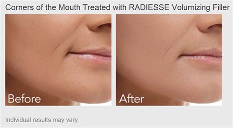 Radiesse Before And After Jowls