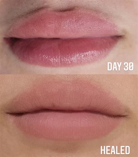 Are Fordyce Spots On Lips Normal - Infoupdate.org