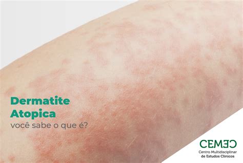 O Que É Pele Atópica - Compreender A Dermatite Atópica – ICWT