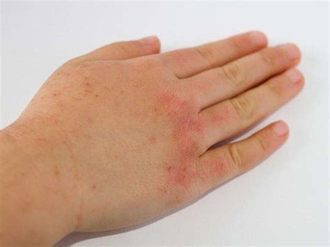 Dermatomyositis: 10 Dermatomyositis Symptoms