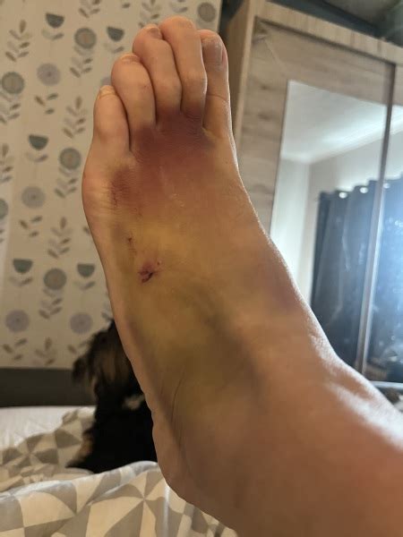 To not worry about my manky foot (horrible pic included) | Mumsnet