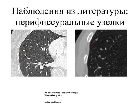Внутрилегочные лимфоузлы (перифиссуральные узелки): что должен знать...