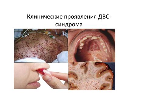 Нарушение системы гемостаза - презентация онлайн