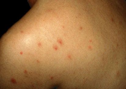 Manchas Na Pele Hiv - FOTOS: Lesões de pele provocadas pelo HIV