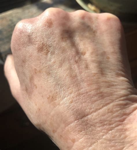 Little Spots On Hands And Arms
